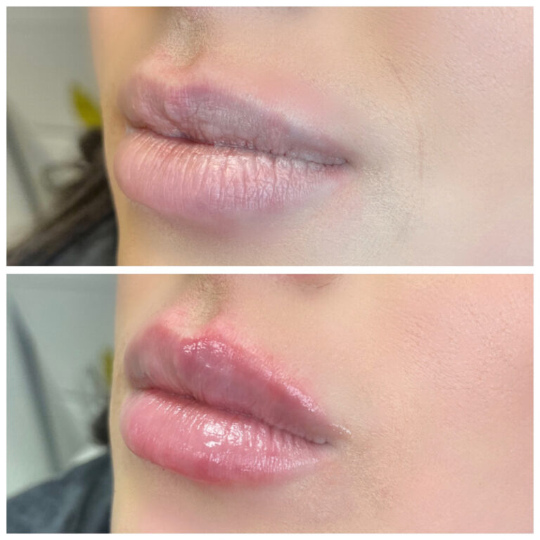 Aesthetic Skin Winnetka Fillers Lip Filler Before After 03