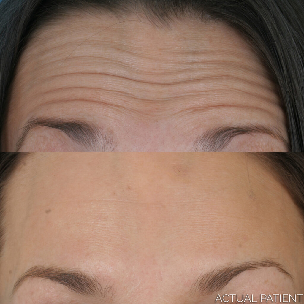 Botox - Before and After 03