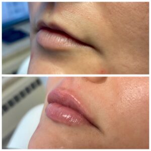 Aesthetic Skin Winnetka Fillers Lip Filler Before and After 03