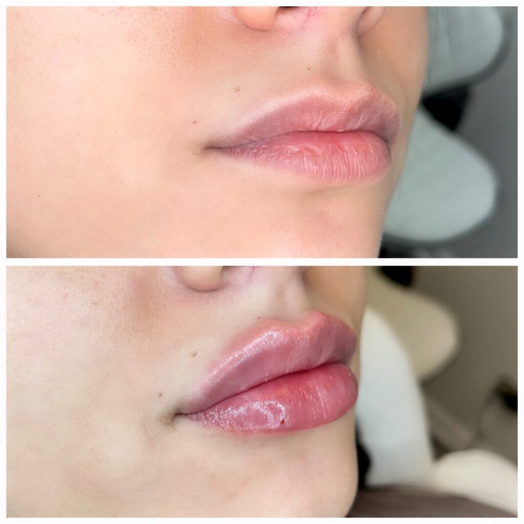 Aesthetic Skin Winnetka Fillers Lip Filler Before and After 05