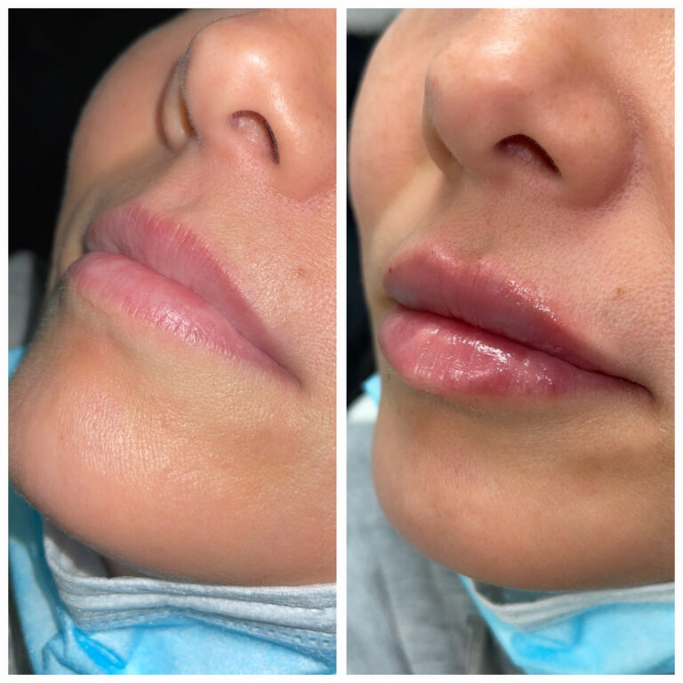Aesthetic Skin Winnetka Fillers Lip Filler Before After 06
