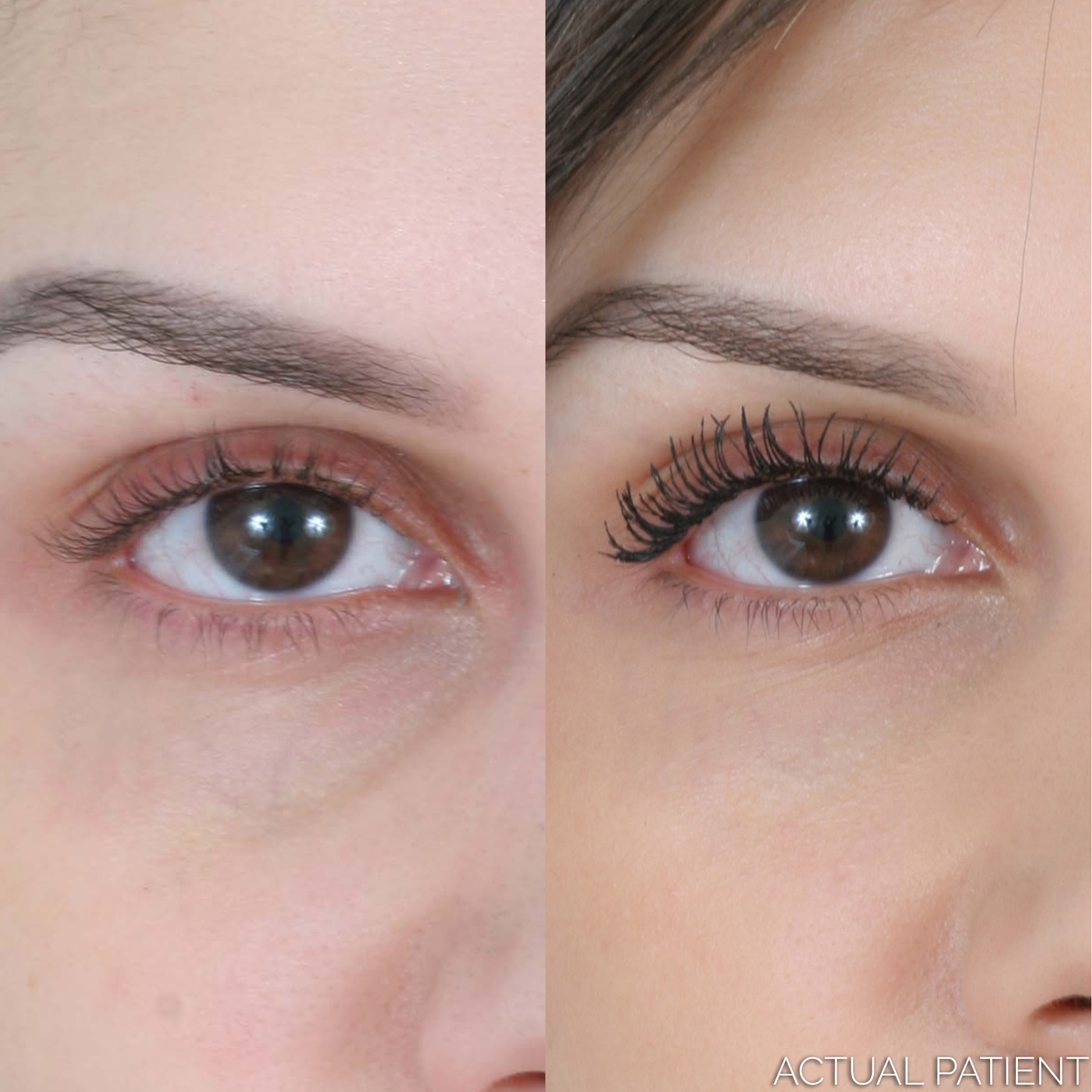 Aesthetic Skin North Shore IL Facial Fillers - Under Eye Filler