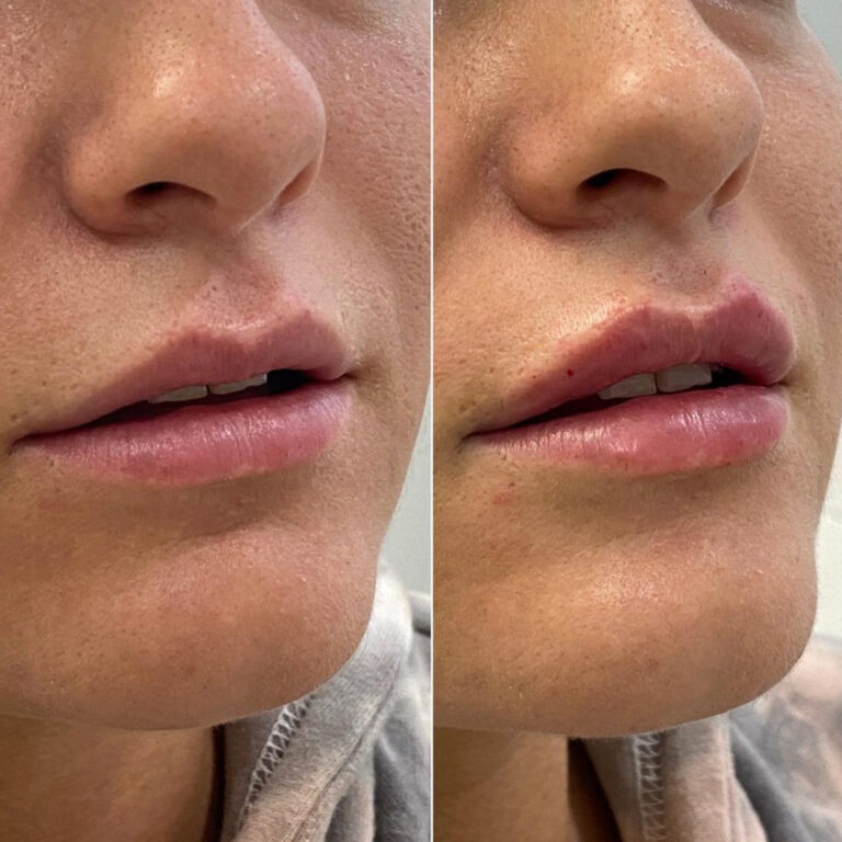 Aesthetic Skin Winnetka Fillers Lip Filler Before After 07