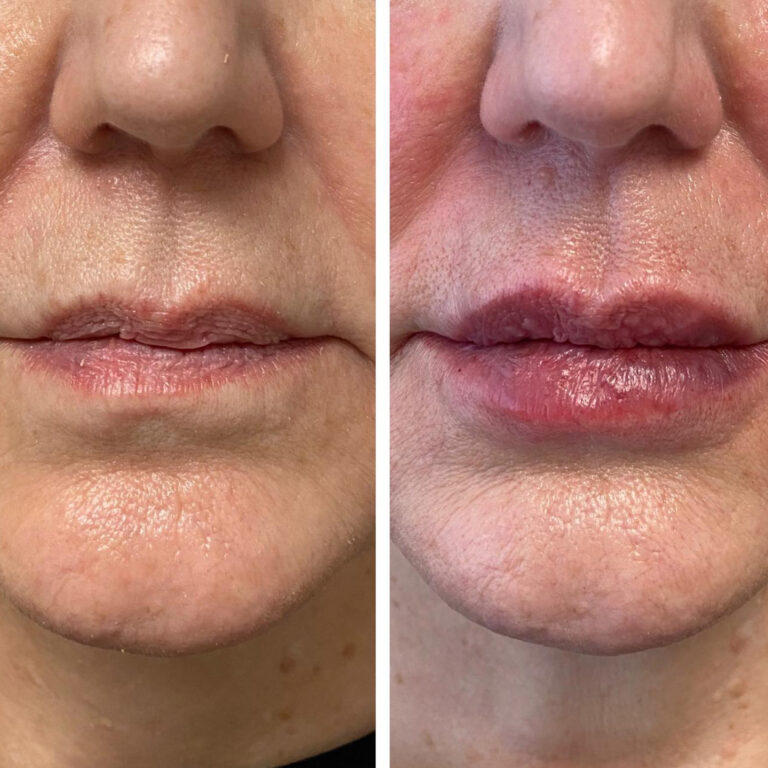 Aesthetic Skin Winnetka Fillers Lip Filler Before After 08