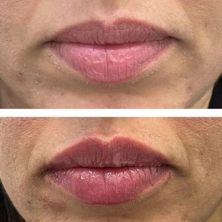 Aesthetic Skin Winnetka Fillers Lip Filler Before and After 09