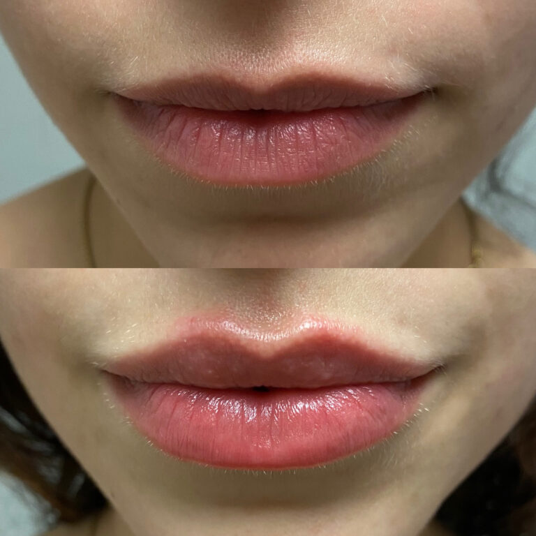 Aesthetic Skin Winnetka Fillers Lip Filler Before and After 10