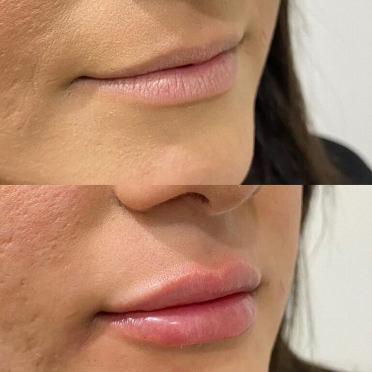 Aesthetic Skin Winnetka Fillers Lip Filler Before After 11