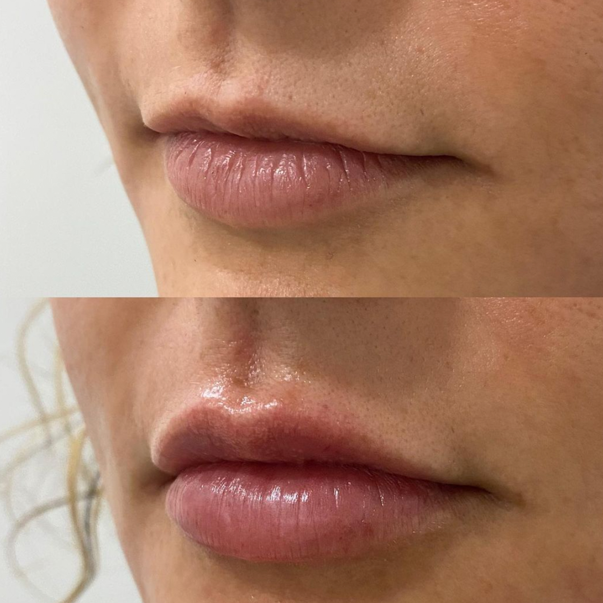 Aesthetic Skin Winnetka Fillers Lip Filler Before and After 12