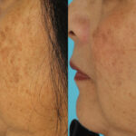 Hyperpigmentation - Brown Spots