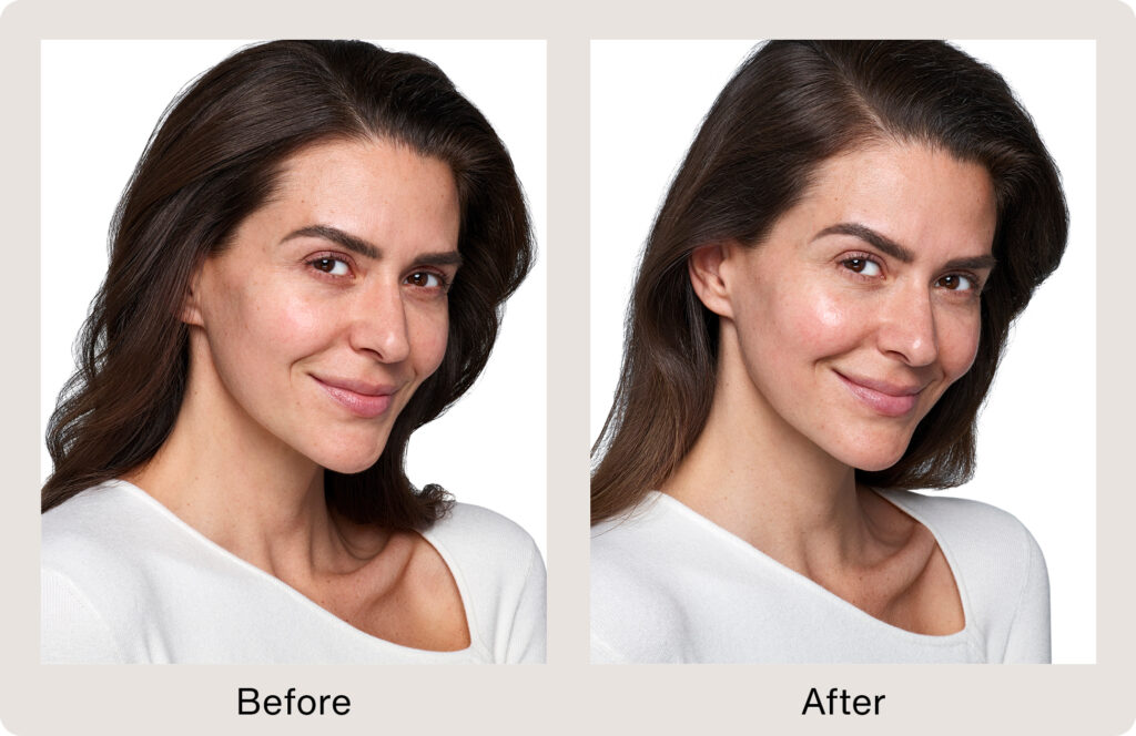 Aesthetic Skin Winnetka IL Skinvive Before And After 01