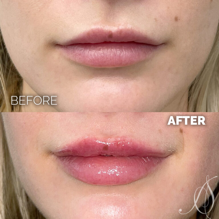 01-23-24 lip filler