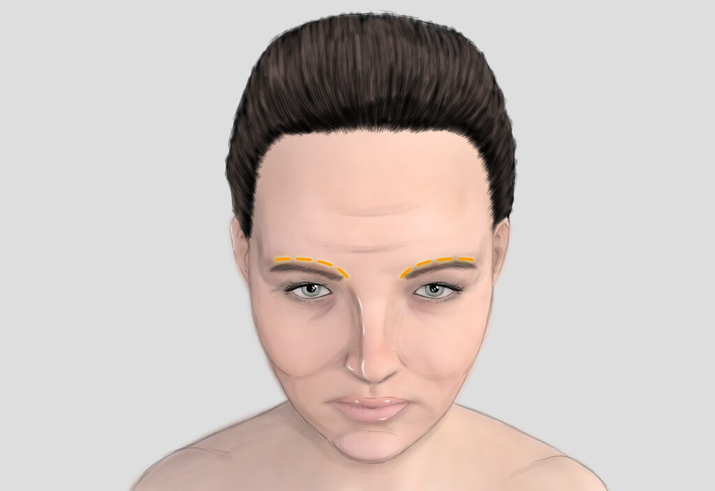 Direct brow lifting. Patient with direct brow lifting, a mid-forehead lift.