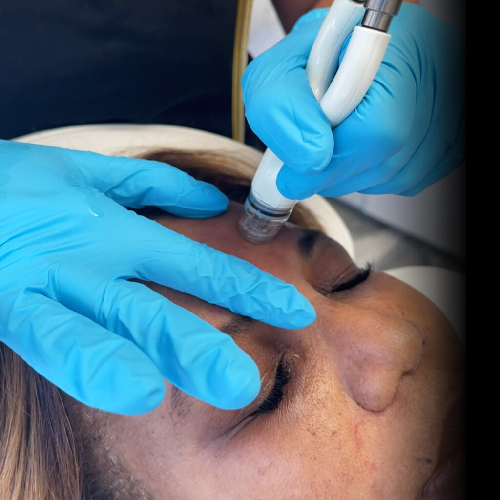 a woman getting a diamond glow facial on her forehead by a provider wearing blue gloves