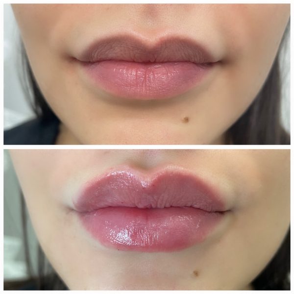 Aesthetic Skin Winnetka Fillers Lip Filler Before and After 02