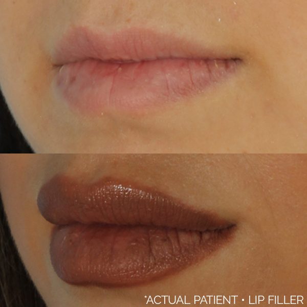 Aesthetic Skin Winnetka Fillers Lip Filler Before and After 01